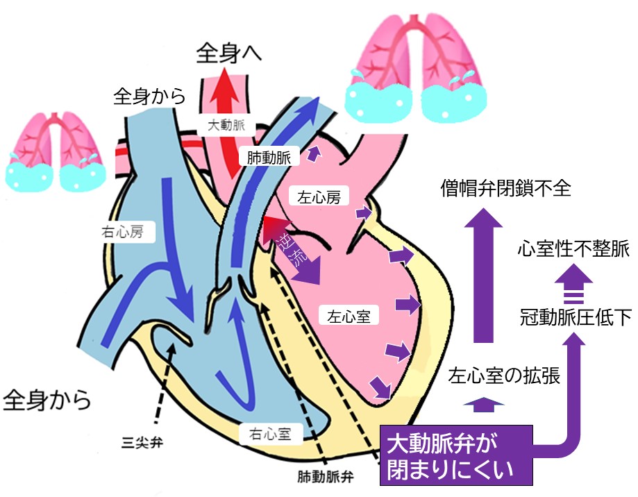 大動脈弁閉鎖不全症はどのように治療されますか?